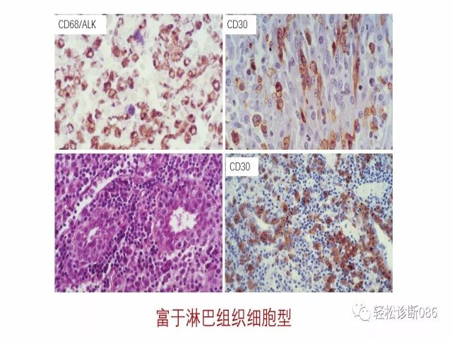 间变大细胞淋巴瘤