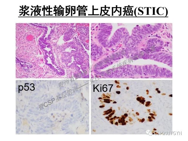 中华病理学会基层培训遵义站讲座（一）——卵巢和输卵管浆液性肿瘤的诊断和鉴别诊断