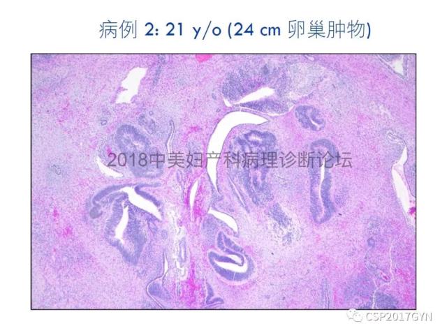 女性生殖道发育