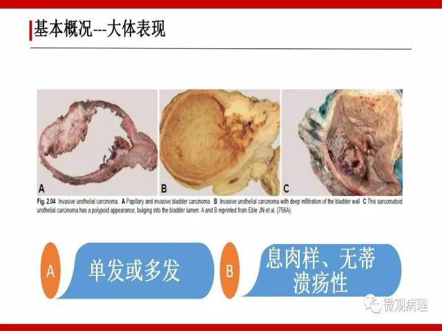 泌尿课程/浸润性尿路上皮癌病理学类型