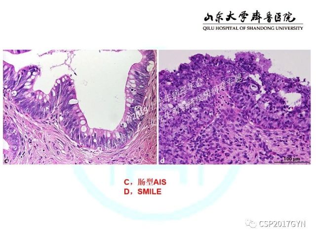 中华病理学会基层培训遵义站讲座（四）——宫颈腺癌的诊断及新分型