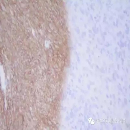 免疫组化结果的分析和常见问题的处理