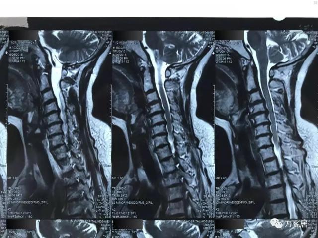 医生及患者通用:如何用手机翻拍X线片,磁共振片子,CT片子进行网络求医、病例讨论及保留资料 医生及患者通用:如何用手机翻拍X线片,磁共振片子,CT片子进行网络求医、病例讨论及保留资料