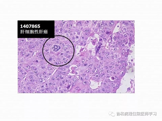 病理学基础知识 : 核分裂像的识别