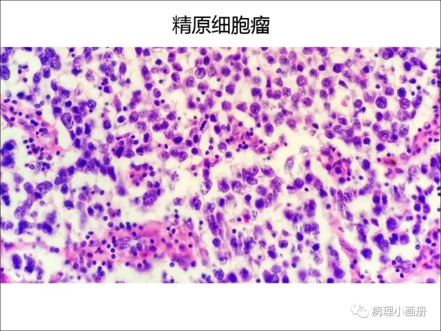 泌尿病理--精原细胞瘤VS精母细胞瘤