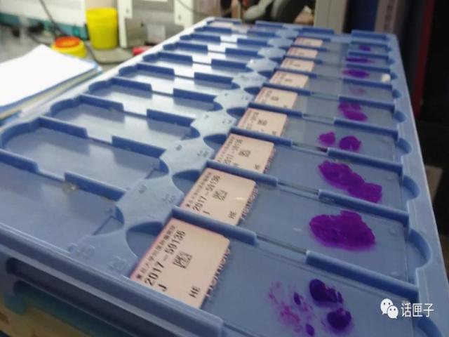 肿瘤还是囊肿?恶性还是良性?他们说了算!这群“幕后高手”,你未必了解…… 肿瘤还是囊肿?恶性还是良性?他们说了算!这群“幕后高手”,你未必了解……