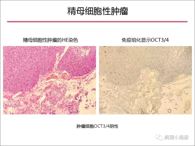 泌尿病理--精原细胞瘤VS精母细胞瘤