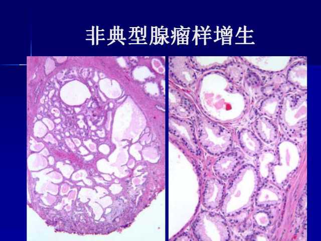 前列腺病理诊断线索（下）——黄教悌