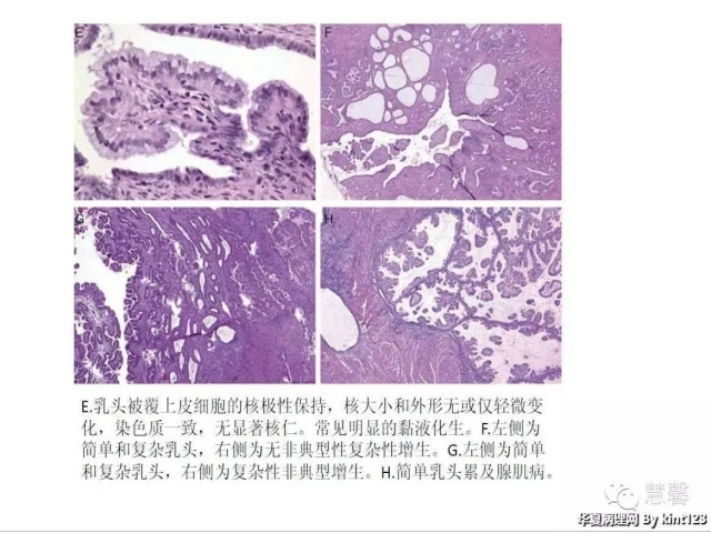 子宫内膜乳头状增生（甜甜分享病例，孔祥田(Max)*Roswell*老师讲解，kent翻译整理文献）
