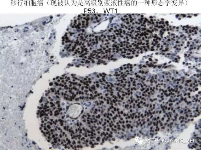 卵巢癌的病理诊断新进展（四）