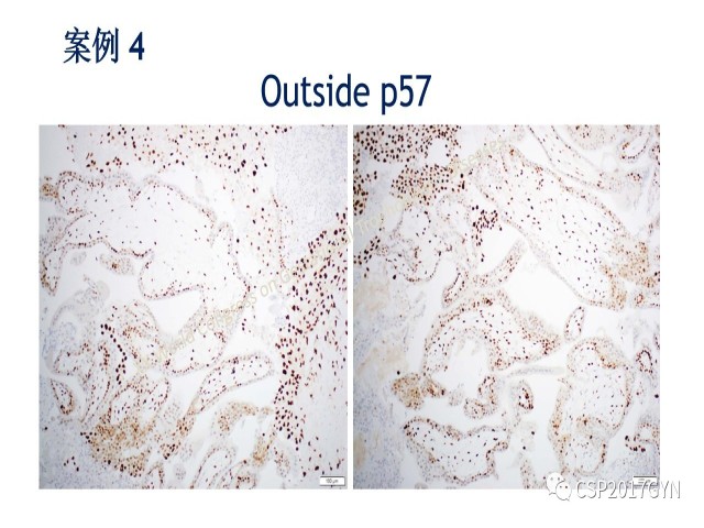 p57免疫组化染色及基因分型 在葡萄胎精确诊断中的应用