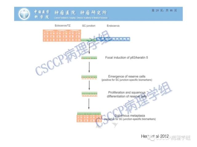 宫颈癌前病变中的诊断难点及阴道镜中ECC的 应用价值