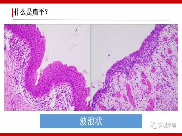 泌尿课程/尿路上皮病变的基本生长方式