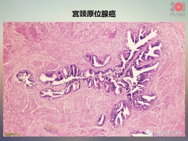 宫颈腺癌的临床病理研究进展