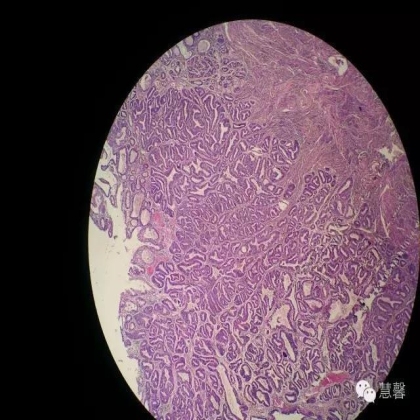子宫内膜癌、宫内膜增殖症的鳞状分化、桑葚化生等问题（石岩分享，刘从容老师讲解）