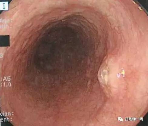 病理解读：神经内分泌癌伴扁平上皮癌