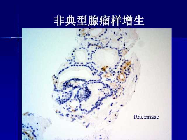 前列腺病理诊断线索（下）——黄教悌