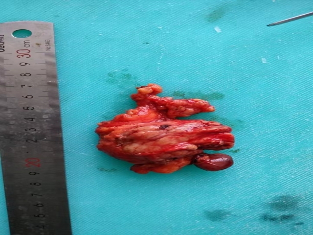 涎腺IG4炎症