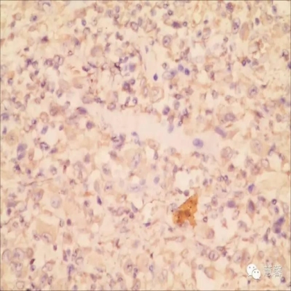 甲状腺癌乳头状癌伴未分化癌（肉瘤样癌）分化