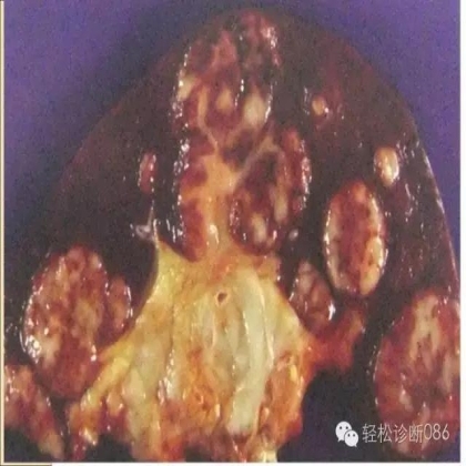 滤泡性淋巴瘤