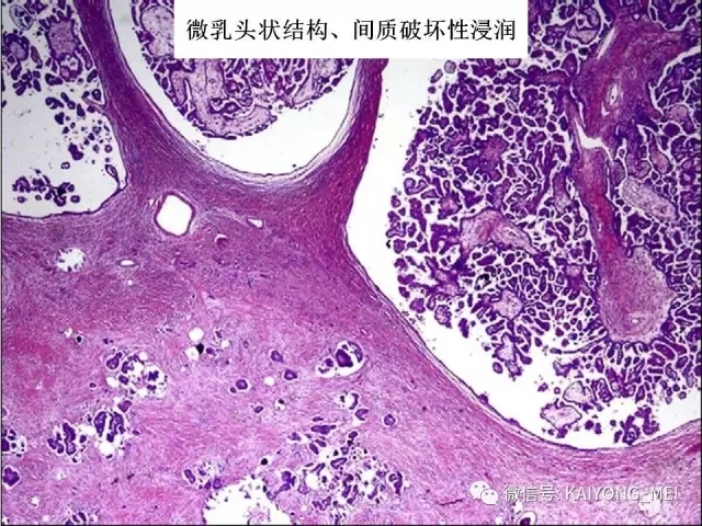 卵巢癌的病理诊断新进展（一）