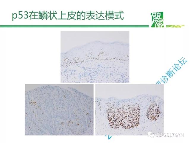 非HPV相关的外阴鳞状细胞肿瘤