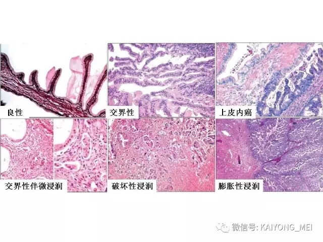 卵巢癌的病理诊断新进展（四）