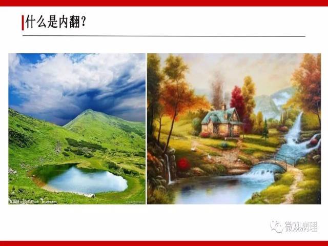 泌尿课程/尿路上皮病变的基本生长方式