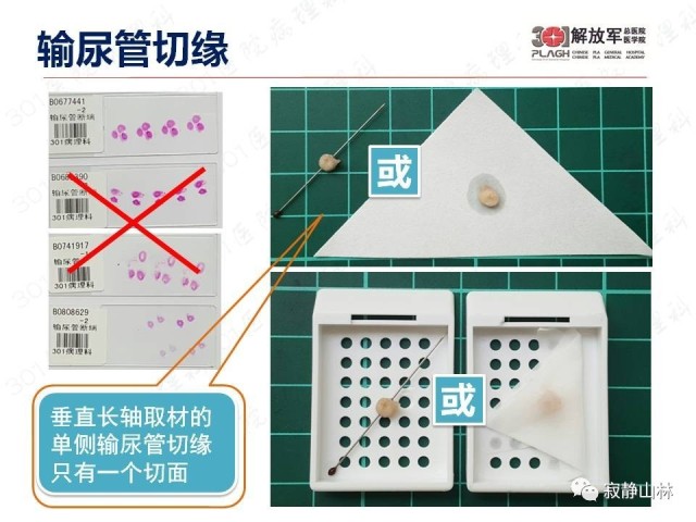 泌尿系统常见肿瘤标本病理报告规范