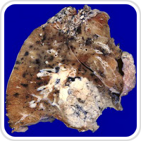 Webpathology.com-镜像翻译（自学使用，版权归原网站所有）