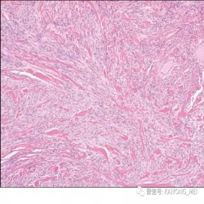 女性生殖道软组织肿瘤病理诊断及进展（二）