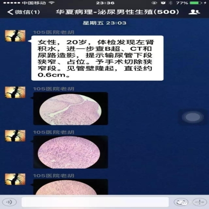 High grade nested variant Urothelial carcinoma(老胡分享，孔祥田老师讲解)