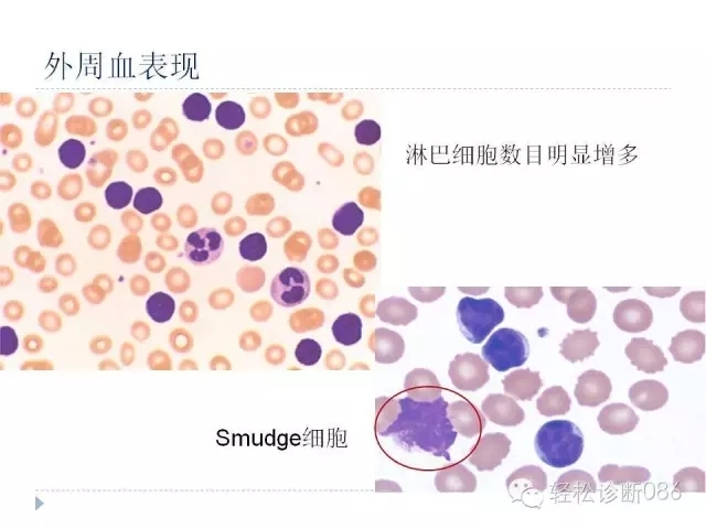 慢性淋巴细胞性白血病