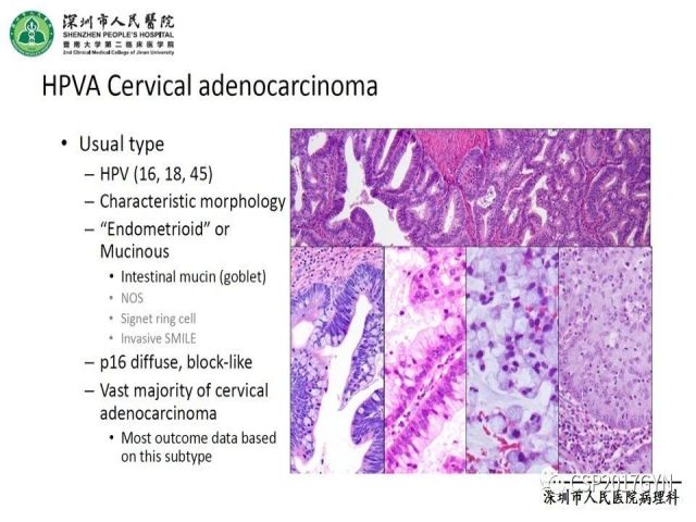 2019USCAP妇科病理热点介绍