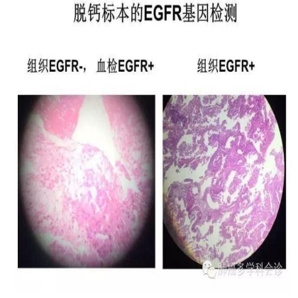 EGFR基因突变检测--基础篇