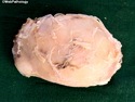 乳腺病理-炎症或反应性病变-乳汁潴留性囊肿