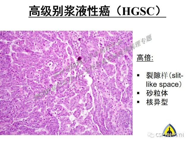 中华病理学会基层培训遵义站讲座（一）——卵巢和输卵管浆液性肿瘤的诊断和鉴别诊断