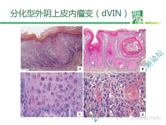 非HPV相关的外阴鳞状细胞肿瘤