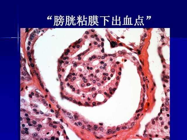 前列腺病理诊断线索（上）——黄教悌