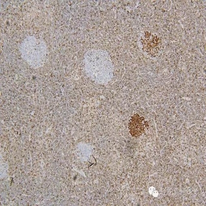 滤泡性淋巴瘤
