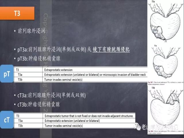 AJCC第8版 前列腺癌分期 之 病理学要点
