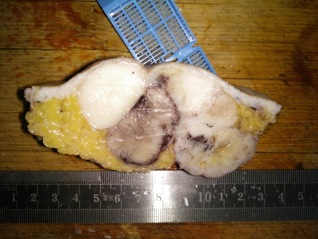 病理科工作札记（二十九）隆突性纤维肉瘤