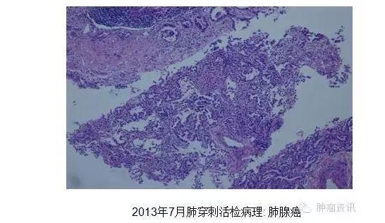 中日韩个体化诊疗案例大赛经典赏析之十——EGFR敏感突变患者，如果TKI原发性耐药，需警惕合并其他驱动基因变异！