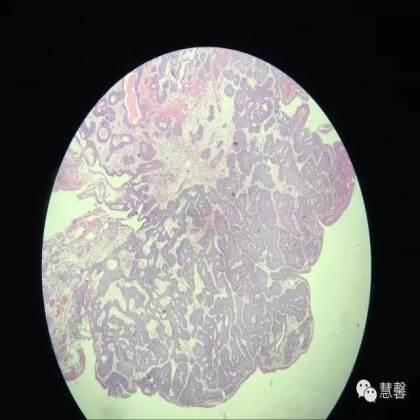 增殖性膀胱炎背景上的内翻性乳头状瘤（孔祥田(Max)*Roswell*NM]讲解）