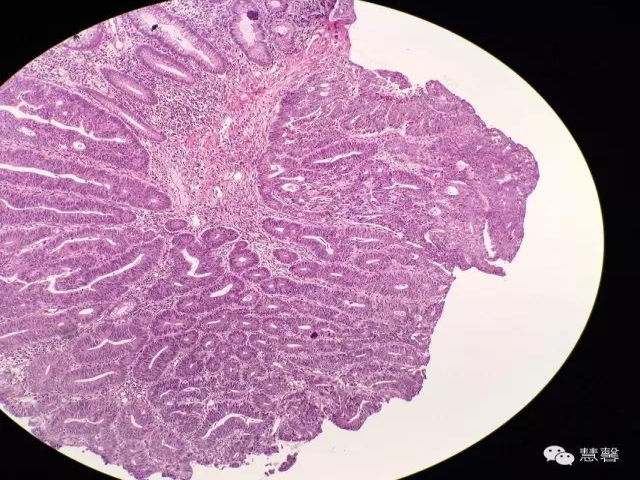 结、直肠管绒毛状腺瘤-高级别病变诊断等相关问题2（悄悄分享、孔祥田(Max)*Roswell*老师讲解）