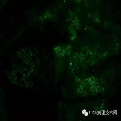 探讨免疫组织学在肾穿标本中的应用