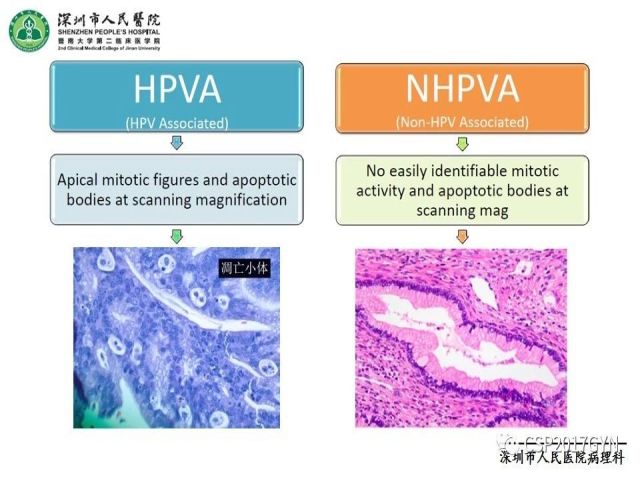 2019USCAP妇科病理热点介绍