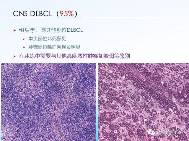 中枢神经系统弥漫大B细胞淋巴瘤
