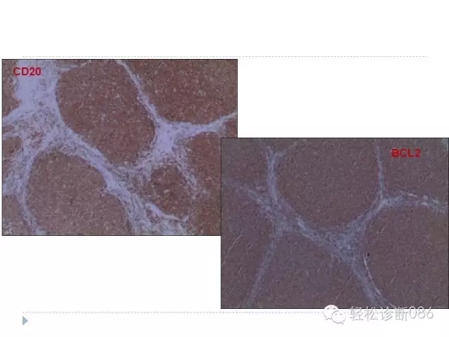 关于套细胞淋巴瘤的总结课件