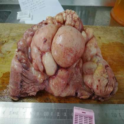 病理科工作札记（二十）小肠系膜脉管囊肿